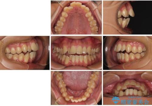 【モニター】前歯のデコボコと口元の出っ張りを改善!目立たない矯正で自然な笑顔にの治療前