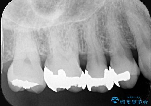 奥歯の銀歯を自然なセラミックに。安心のメタルフリー治療の治療前