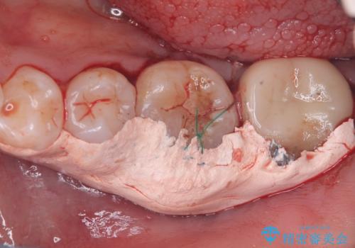 【歯牙移植】奥歯抜歯と言われたので親知らずを移植してほしいの治療中