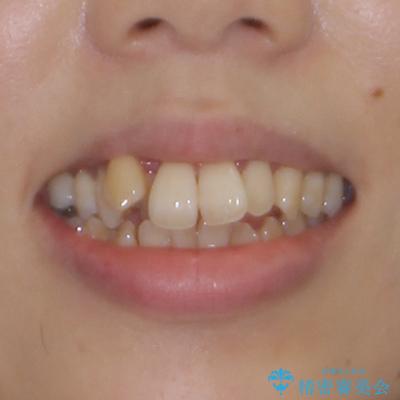 急速拡大装置 狭い骨幅を拡大した上で、顕著なデコボコを改善する抜歯矯正治療の治療前(顔貌)