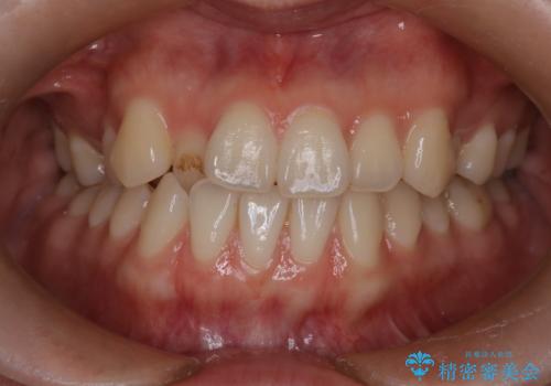 八重歯と前歯の逆の咬み合わせを、目立たない矯正で同時に改善の治療前