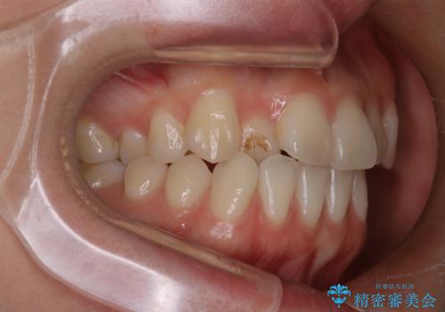 八重歯と前歯の逆の咬み合わせを、目立たない矯正で同時に改善の治療前