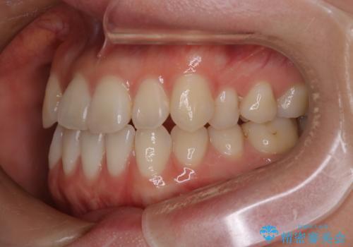 八重歯と前歯の逆の咬み合わせを、目立たない矯正で同時に改善の治療前