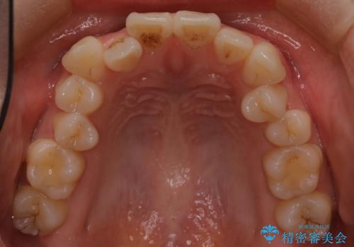 八重歯と前歯の逆の咬み合わせを、目立たない矯正で同時に改善の治療前
