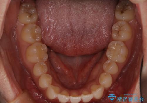 八重歯と前歯の逆の咬み合わせを、目立たない矯正で同時に改善の治療前