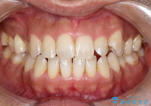 八重歯のデコボコを、目立たない矯正で解消