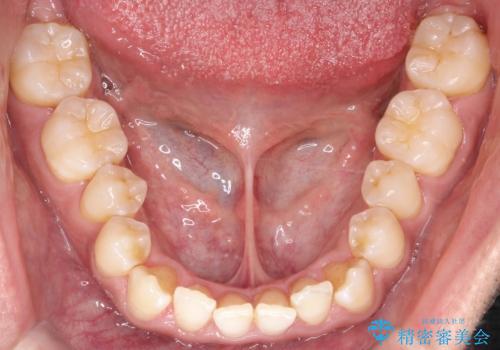 八重歯のデコボコを、目立たない矯正で解消の治療前