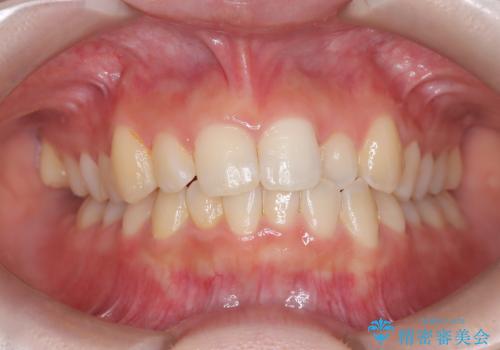 前歯の逆の咬み合わせを、目立たない矯正でスムーズに改善