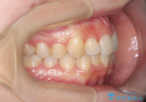 前歯の逆の咬み合わせを、目立たない矯正でスムーズに改善の治療前