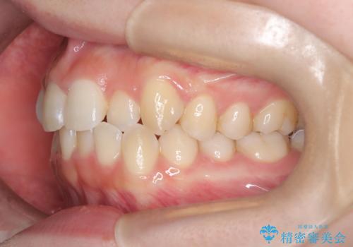 前歯の逆の咬み合わせを、目立たない矯正でスムーズに改善の治療前