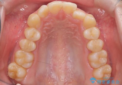 前歯の逆の咬み合わせを、目立たない矯正でスムーズに改善の治療前