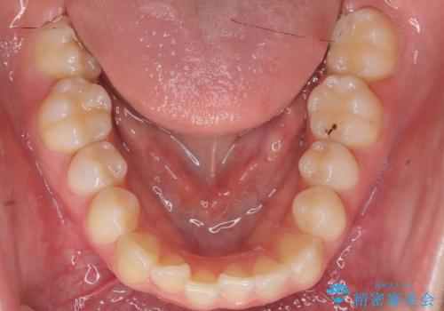 前歯の逆の咬み合わせを、目立たない矯正でスムーズに改善の治療前