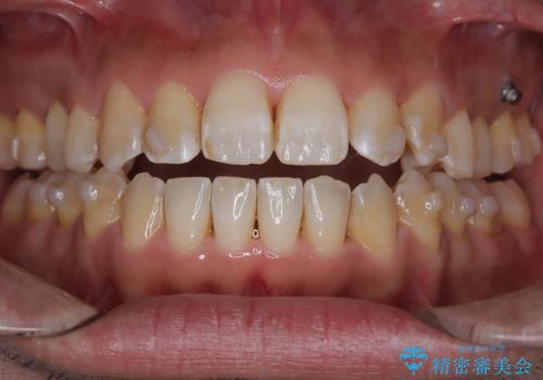 八重歯のデコボコを、目立たない矯正で解消の治療中