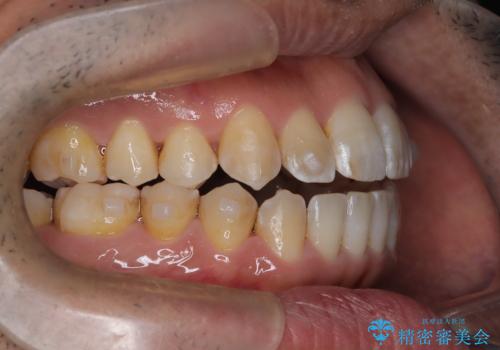 八重歯のデコボコを、目立たない矯正で解消の治療中