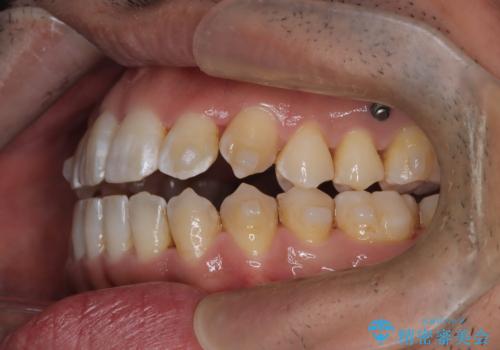 八重歯のデコボコを、目立たない矯正で解消の治療中