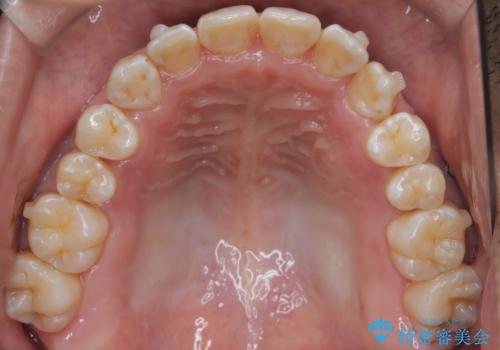 八重歯のデコボコを、目立たない矯正で解消の治療中