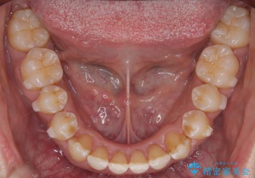 八重歯のデコボコを、目立たない矯正で解消の治療中