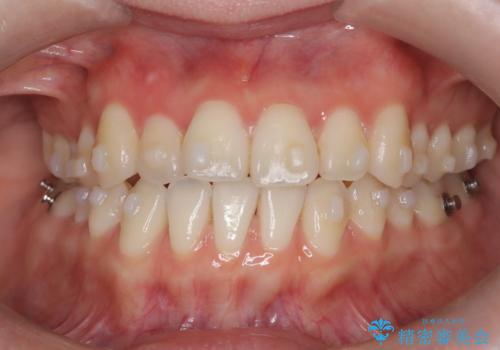 八重歯と前歯の逆の咬み合わせを、目立たない矯正で同時に改善の治療中