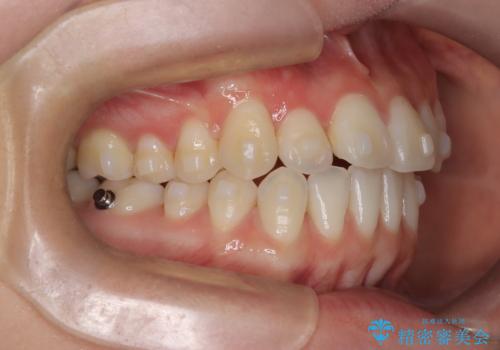 八重歯と前歯の逆の咬み合わせを、目立たない矯正で同時に改善の治療中