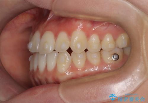八重歯と前歯の逆の咬み合わせを、目立たない矯正で同時に改善の治療中