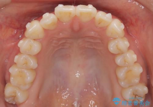 八重歯と前歯の逆の咬み合わせを、目立たない矯正で同時に改善の治療中