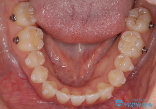 八重歯と前歯の逆の咬み合わせを、目立たない矯正で同時に改善の治療中
