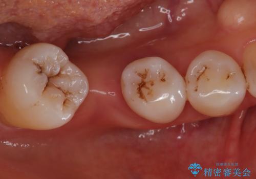 歯周病治療、部分矯正、インプラントを組み合わせた奥歯の治療の症例 治療前