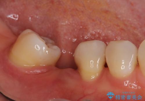 歯周病治療、部分矯正、インプラントを組み合わせた奥歯の治療の治療前