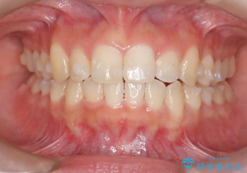 前歯の逆の咬み合わせを、目立たない矯正でスムーズに改善の治療中