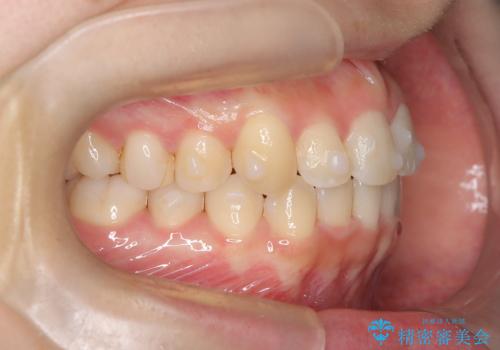 前歯の逆の咬み合わせを、目立たない矯正でスムーズに改善の治療中