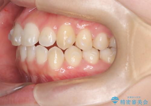 前歯の逆の咬み合わせを、目立たない矯正でスムーズに改善の治療中