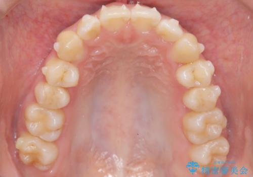 前歯の逆の咬み合わせを、目立たない矯正でスムーズに改善の治療中