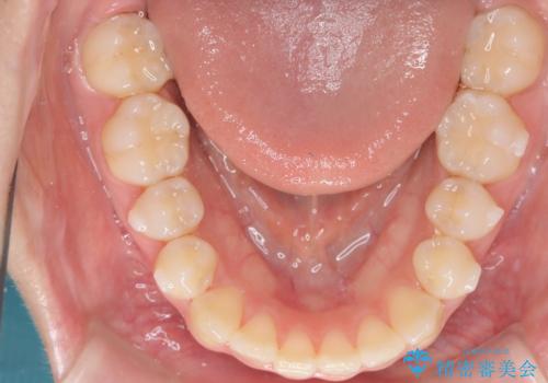 前歯の逆の咬み合わせを、目立たない矯正でスムーズに改善の治療中