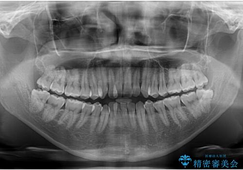 【モニター】前歯のデコボコと口元の出っ張りを改善!目立たない矯正で自然な笑顔にの治療前
