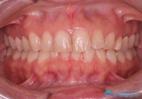 下の前歯のデコボコを、目立たない矯正ですっきりとの治療前