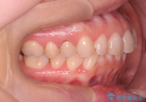 下の前歯のデコボコを、目立たない矯正ですっきりとの治療前