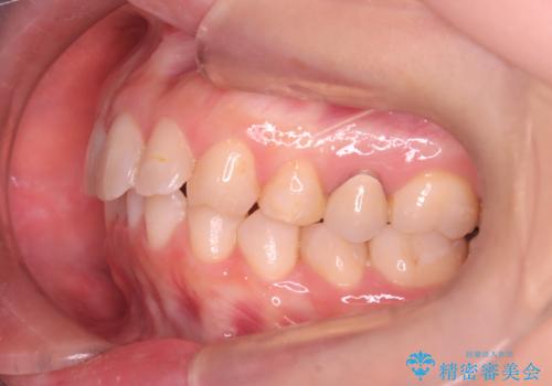 下の前歯のデコボコを、目立たない矯正ですっきりとの治療前