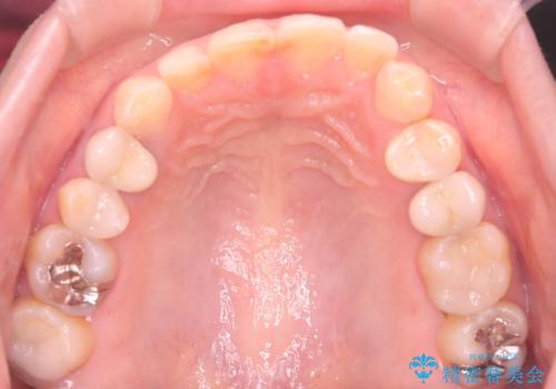 下の前歯のデコボコを、目立たない矯正ですっきりとの治療前