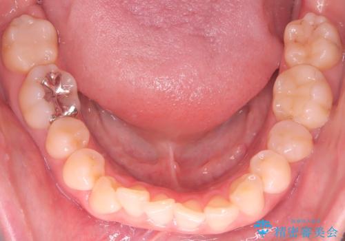 下の前歯のデコボコを、目立たない矯正ですっきりとの治療前