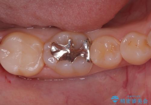 奥歯の銀歯を自然に!右下6番のメタルフリー治療の治療前