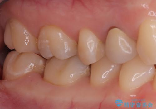 奥歯の銀歯を自然に!右下6番のメタルフリー治療の治療前