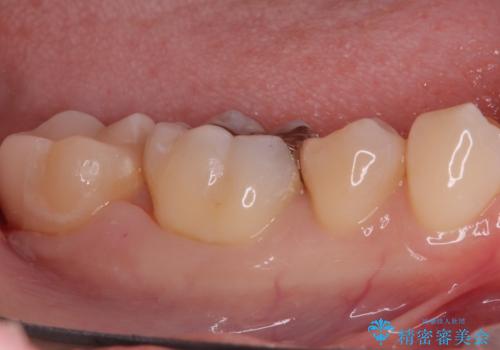 奥歯の銀歯を自然に!右下6番のメタルフリー治療の治療前