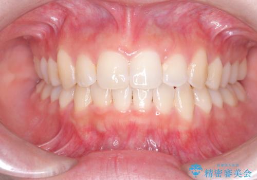 前歯の逆の咬み合わせを、目立たない矯正でスムーズに改善の治療後