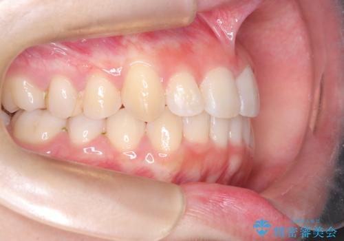 前歯の逆の咬み合わせを、目立たない矯正でスムーズに改善の治療後