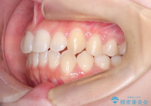 前歯の逆の咬み合わせを、目立たない矯正でスムーズに改善の治療後