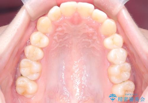 前歯の逆の咬み合わせを、目立たない矯正でスムーズに改善の治療後