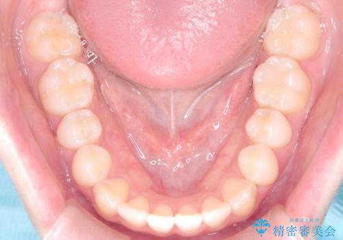 前歯の逆の咬み合わせを、目立たない矯正でスムーズに改善の治療後