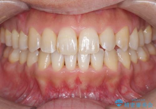 八重歯のデコボコを、目立たない矯正で解消の治療後