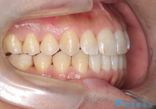 八重歯のデコボコを、目立たない矯正で解消の治療後