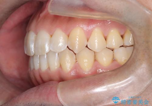 八重歯のデコボコを、目立たない矯正で解消の治療後